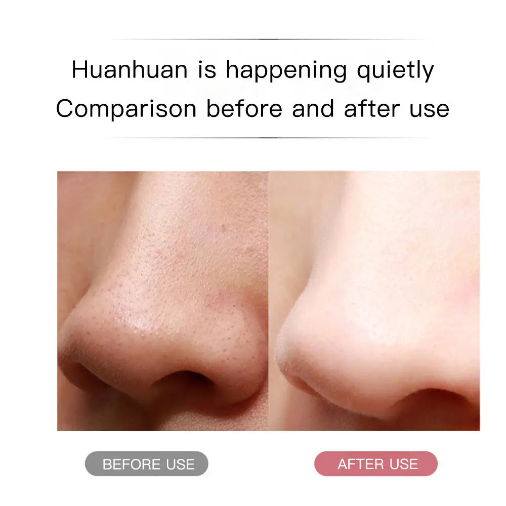 Electric Skin Scrubber Blackhead Remover Dead Skin Acne Scalper Vibration Facial Clean